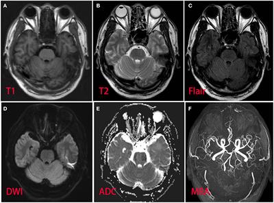 Case Report: Early-Onset Guillain–Barre Syndrome Mimicking Stroke